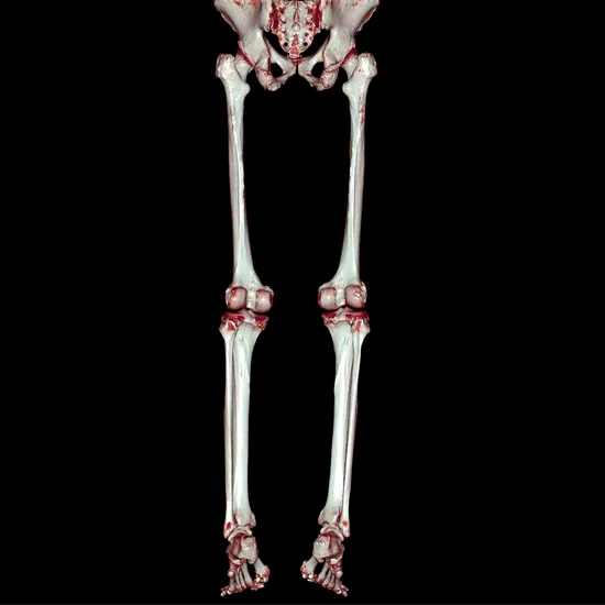 3D CT Thigh